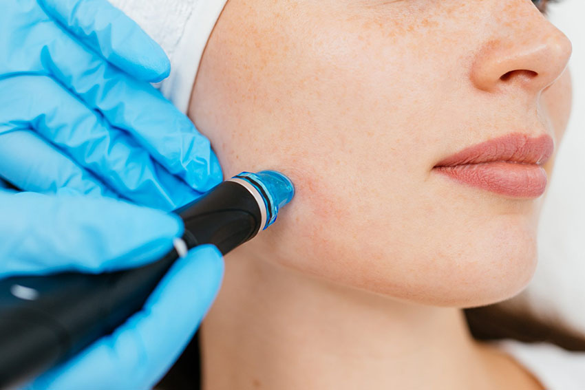 Close up of a woman's face, undergoing microneedling treatment. Image shows mouth, nose and jawline and a pair of blue gloved hands holding the microneedling wand on the jawline.