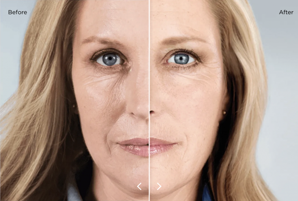 Close up of a woman's face - the image is split into two to show the before and after effects of using Sculptra. The right hand side of the face has smoother skin and less wrinkles.