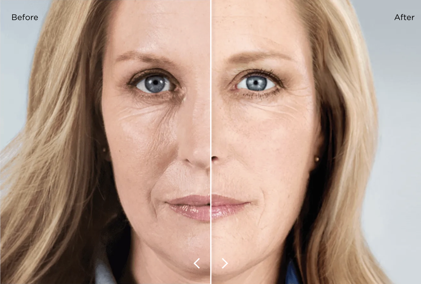 Close up of a woman's face - the image is split into two to show the before and after effects of using Sculptra. The right hand side of the face has smoother skin and less wrinkles.