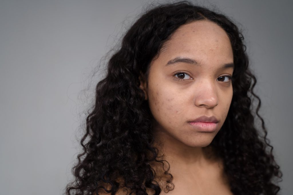 Head of a woman with long dark wavy hair, looking directly at the camera with a sad expression and some signs of acne scarring on her cheeks.