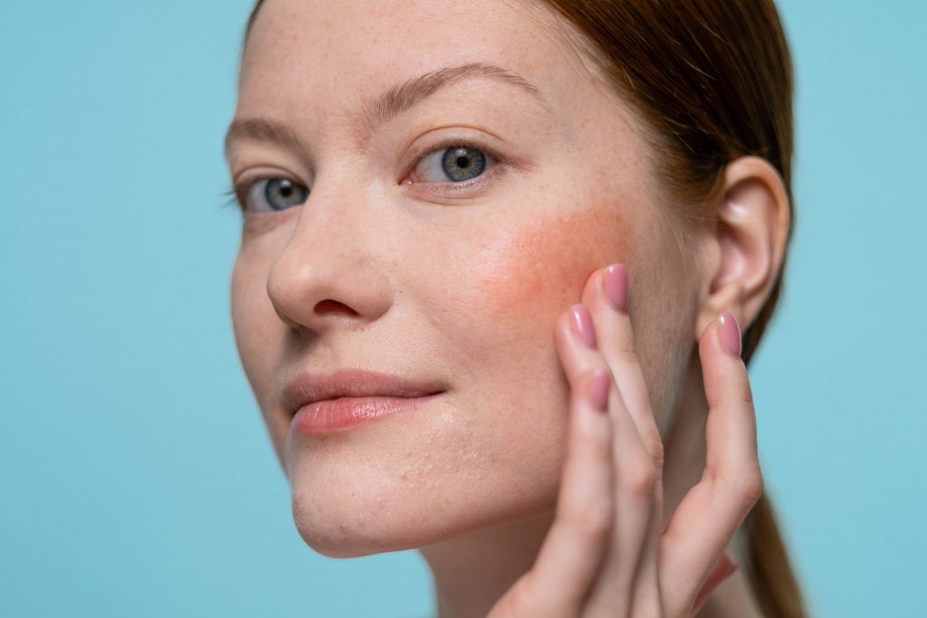 Close up of a woman's face, side on showing a patch of redness on her cheek. One hand is touching the cheek and the women is looking directly at the camera.